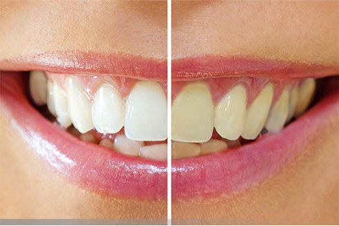 Bleaching - Strahlen weiße Zähne