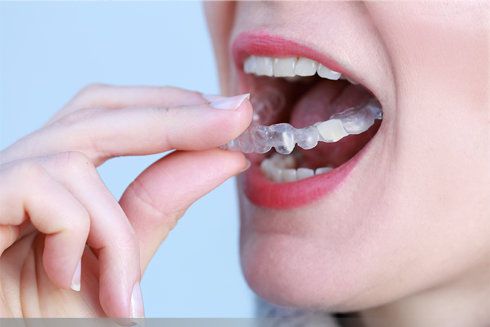 Schienentherapie funktionell/ästhetisch